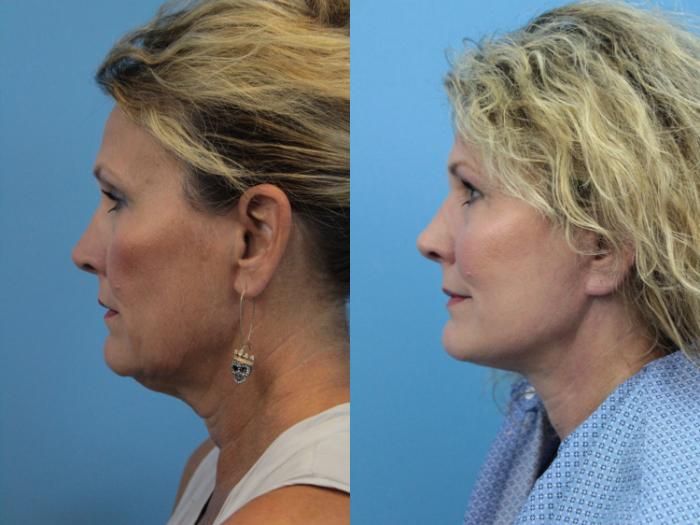 Before & After Facelift Case 397 Left Side View in West Des Moines & Ames, IA