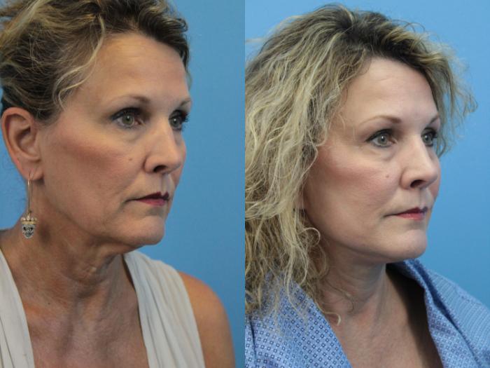 Before & After Facelift Case 397 Right Oblique View in West Des Moines & Ames, IA