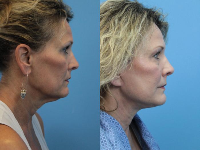 Before & After Facial Liposuction Case 397 Right Side View in West Des Moines & Ames, IA