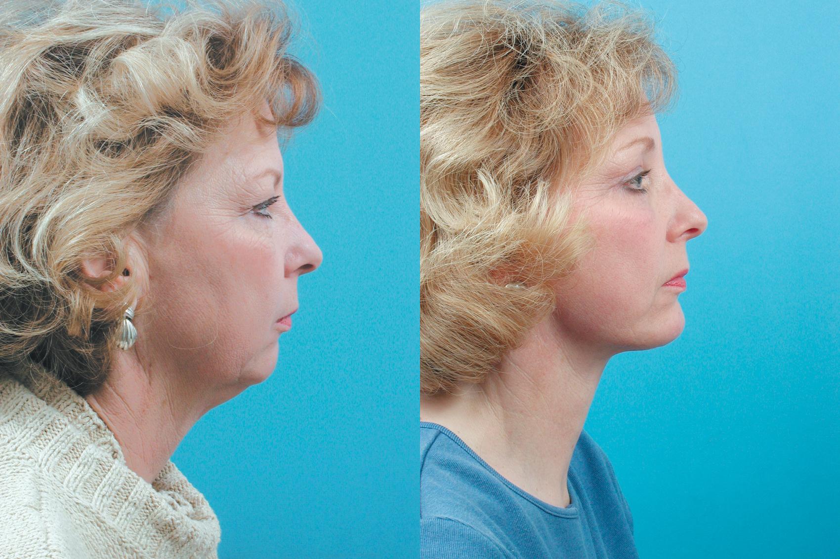 Before & After Facelift Case 4 View #2 View in West Des Moines & Ames, IA