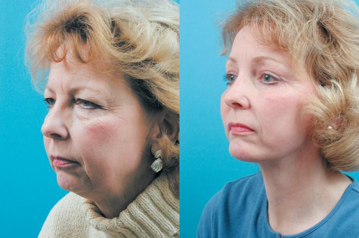 Before & After Facelift Case 4 View #3 View in West Des Moines & Ames, IA