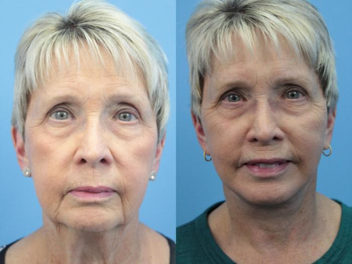 Before & After Facial Liposuction Case 400 Front View in West Des Moines & Ames, IA