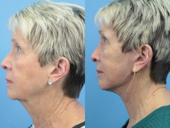 Before & After Facial Liposuction Case 400 Left Side View in West Des Moines & Ames, IA