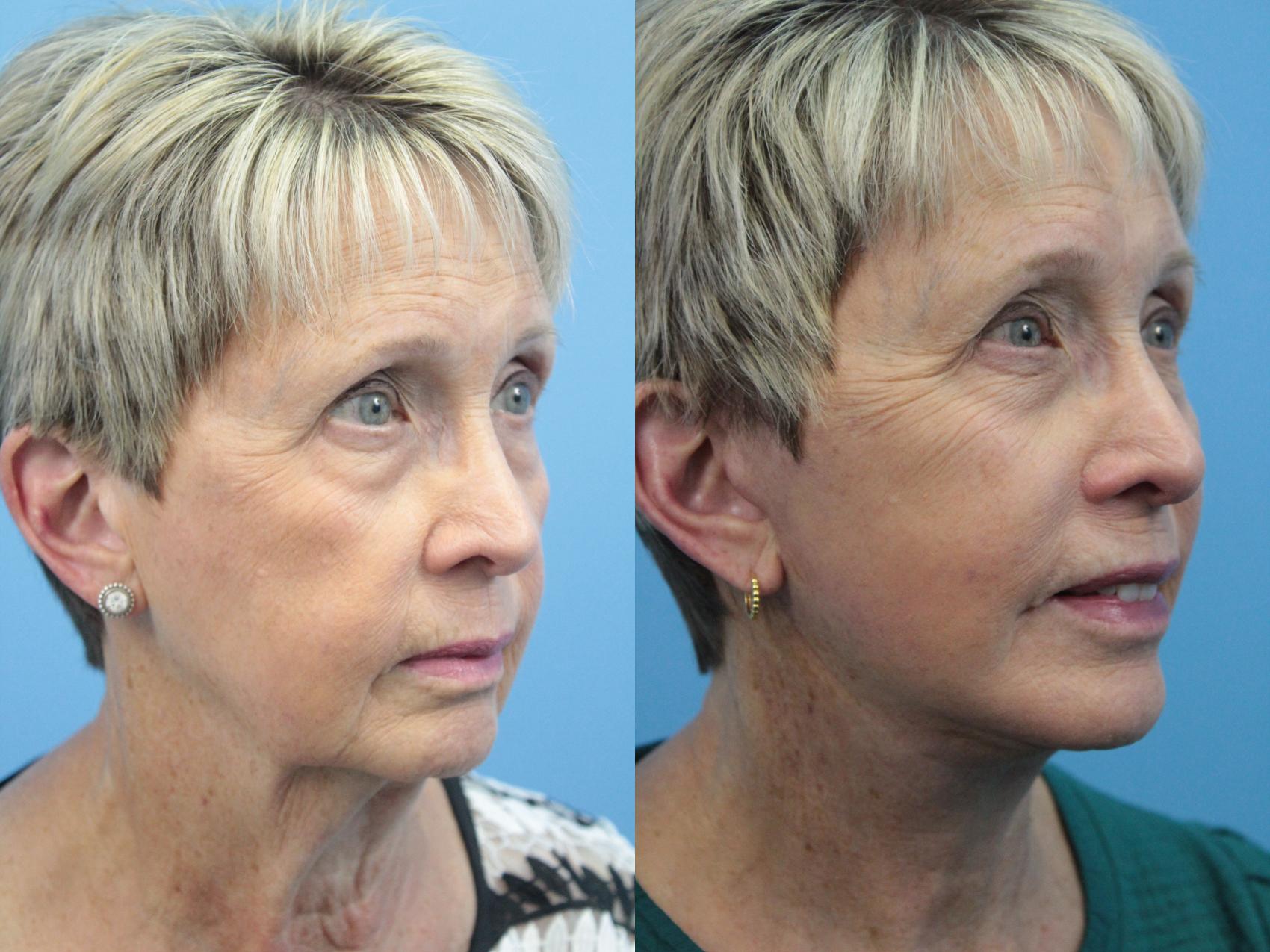 Before & After Facelift Case 400 Right Oblique View in West Des Moines & Ames, IA
