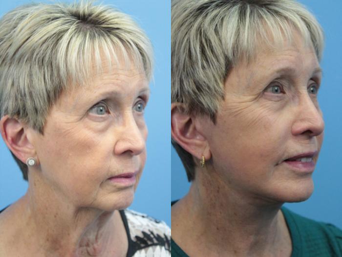 Before & After Facial Liposuction Case 400 Right Oblique View in West Des Moines & Ames, IA
