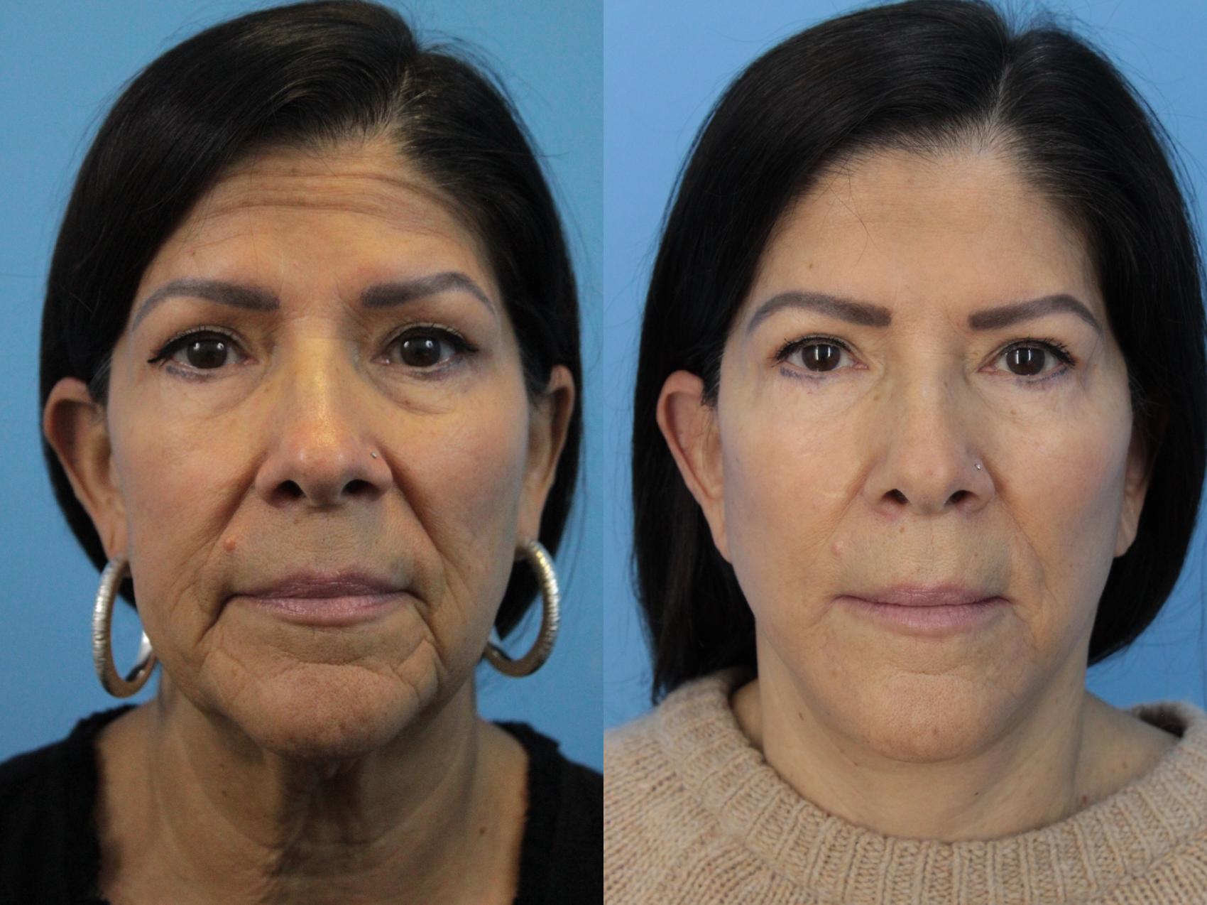 Before & After Facelift Case 405 Front View in West Des Moines & Ames, IA