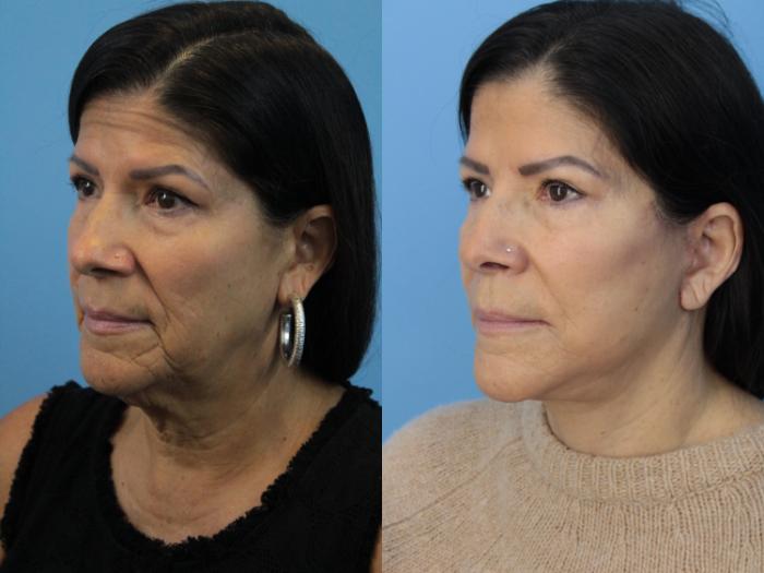 Before & After Facial Liposuction Case 405 Left Oblique View in West Des Moines & Ames, IA