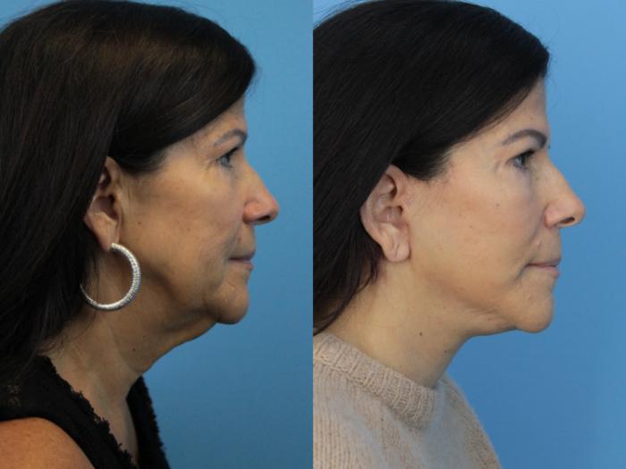 Before & After Facial Liposuction Case 405 Right Side View in West Des Moines & Ames, IA