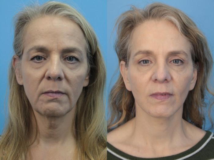 Before & After Blepharoplasty (Upper Eyelid Lift) Case 407 Front View in West Des Moines & Ames, IA