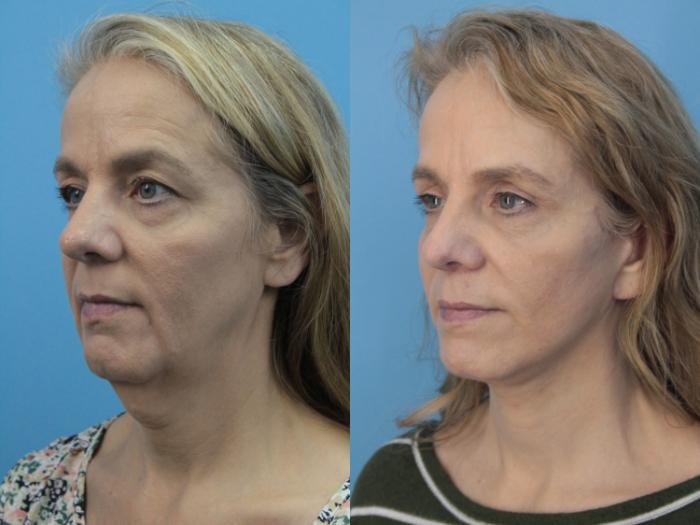 Before & After Facial Liposuction Case 407 Left Oblique View in West Des Moines & Ames, IA