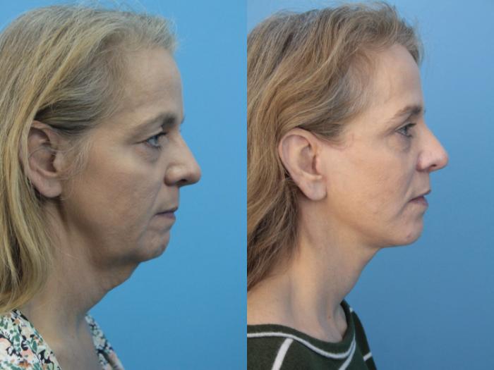 Before & After Facial Liposuction Case 407 Right Side View in West Des Moines & Ames, IA
