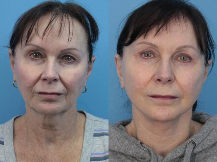 Before & After Blepharoplasty (Upper Eyelid Lift) Case 408 Front View in West Des Moines & Ames, IA