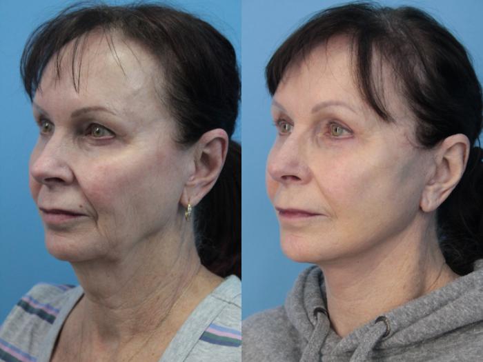 Before & After Blepharoplasty (Lower, Under Eyes) Case 408 Left Oblique View in West Des Moines & Ames, IA