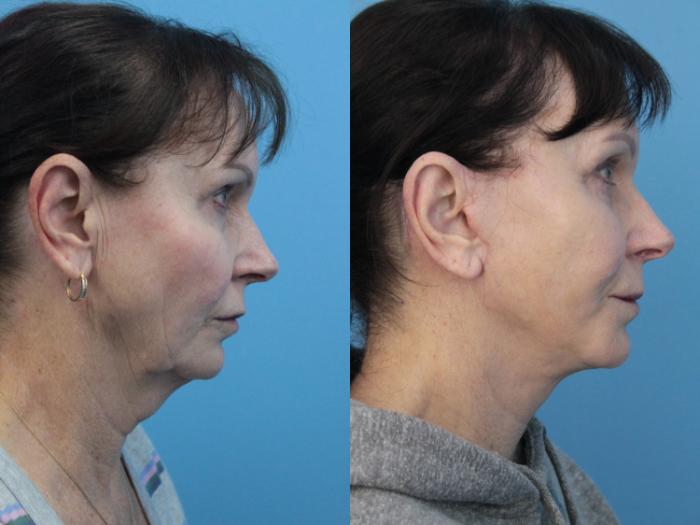 Before & After Blepharoplasty (Upper Eyelid Lift) Case 408 Right Side View in West Des Moines & Ames, IA