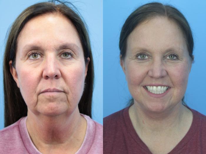 Before & After Facelift Case 416 Front View in West Des Moines & Ames, IA