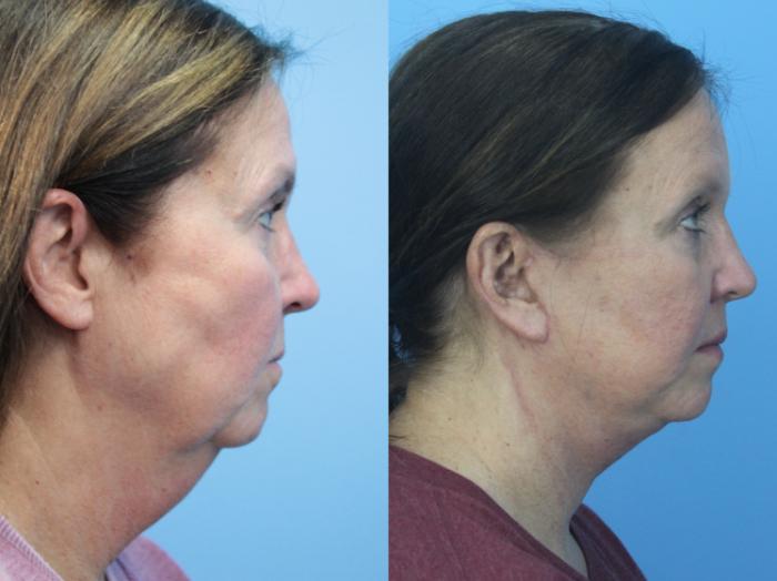 Before & After Facelift Case 416 Right Side View in West Des Moines & Ames, IA