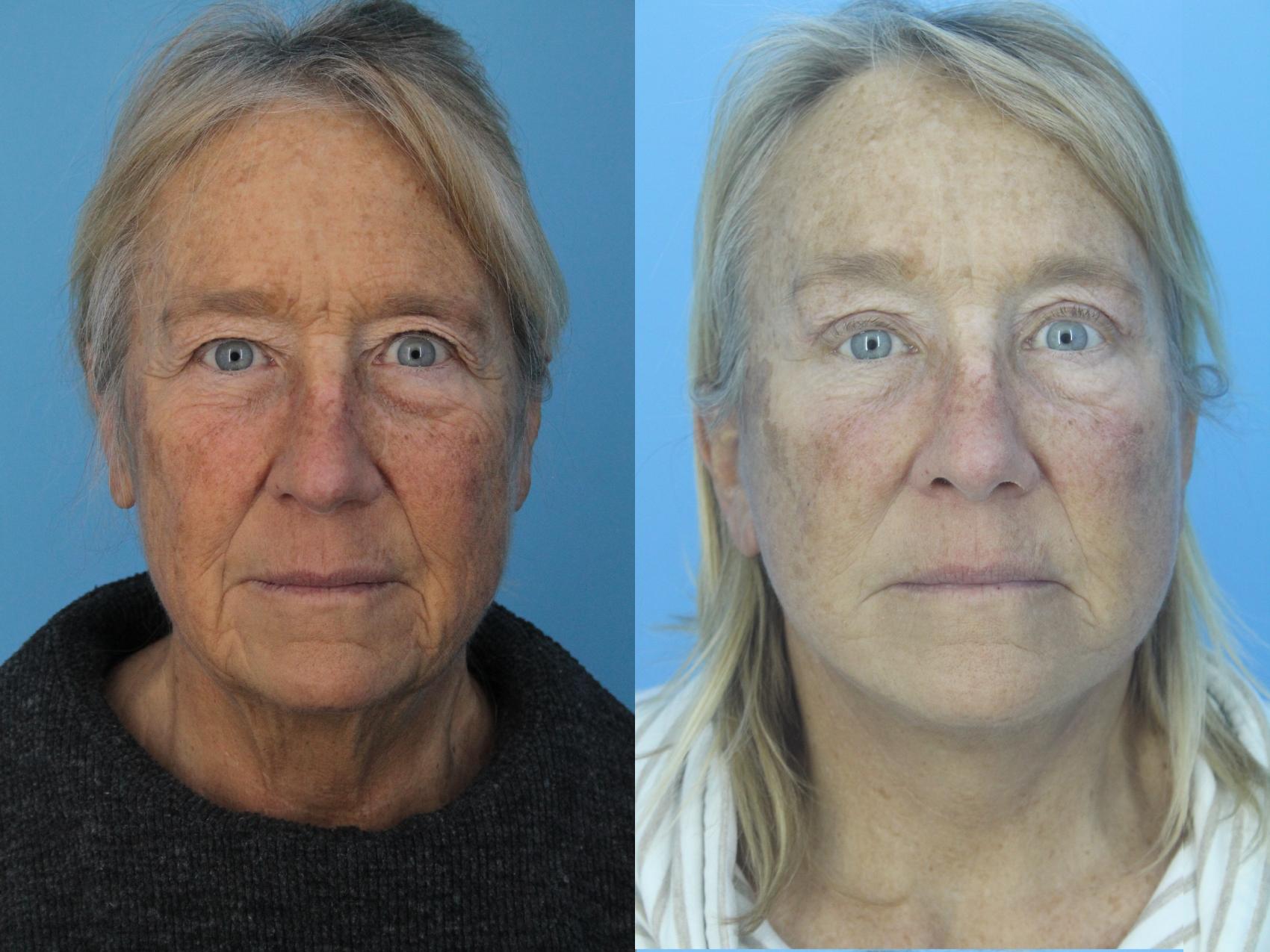 Before & After Facelift Case 417 Front View in West Des Moines & Ames, IA