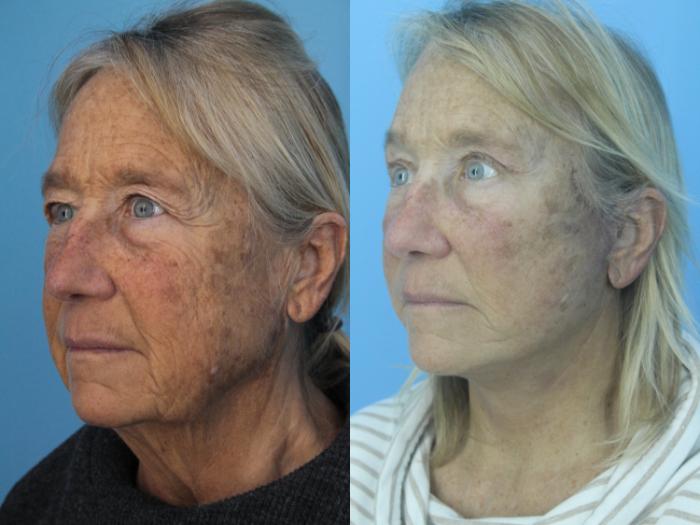 Before & After Facial Liposuction Case 417 Left Oblique View in West Des Moines & Ames, IA