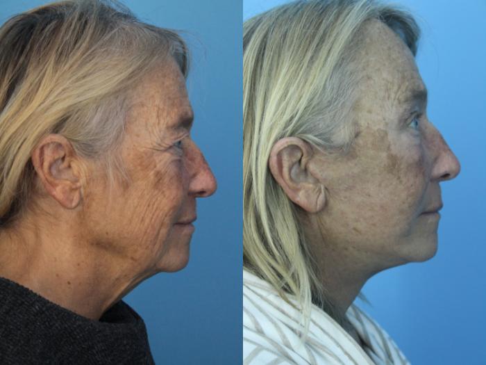 Before & After Facial Liposuction Case 417 Right Side View in West Des Moines & Ames, IA