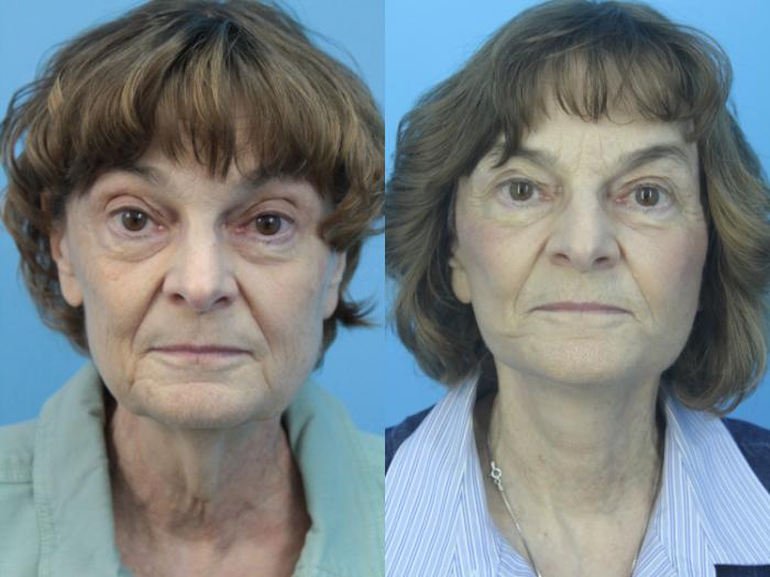 Before & After Facelift Case 418 Front View in West Des Moines & Ames, IA