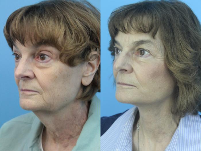 Before & After Facelift Case 418 Left Oblique View in West Des Moines & Ames, IA