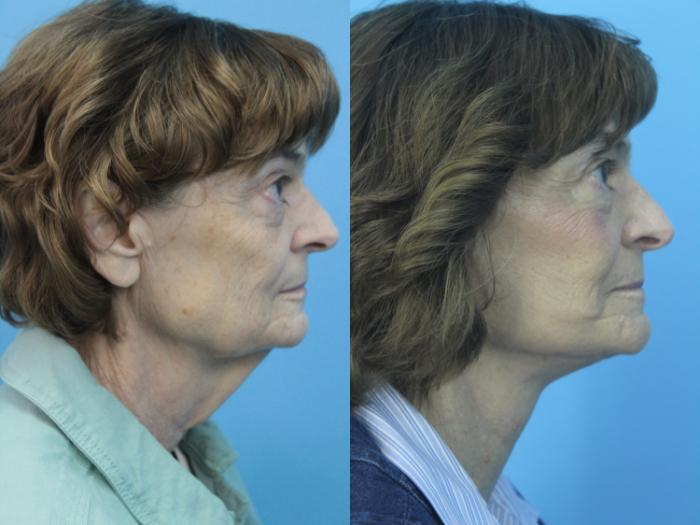 Before & After Facelift Case 418 Right Side View in West Des Moines & Ames, IA