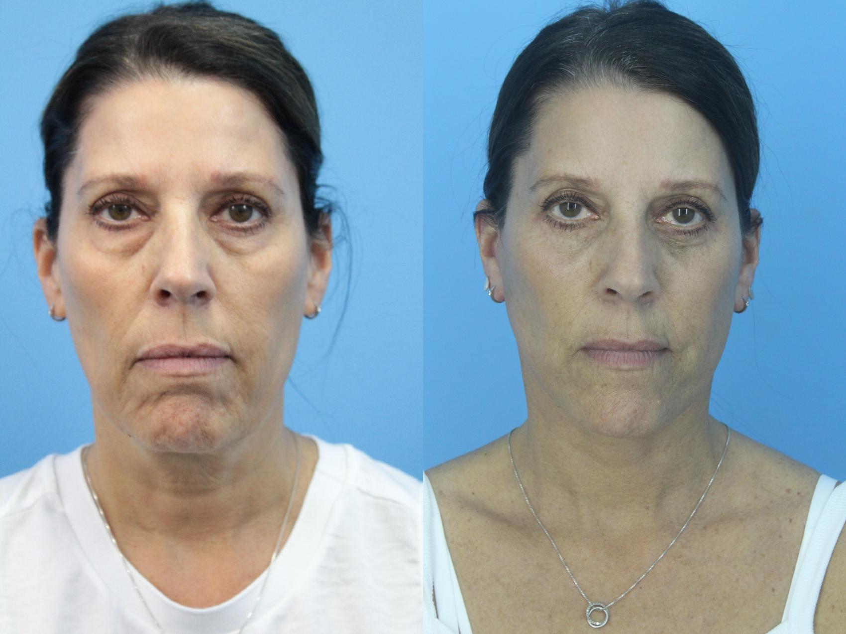 Before & After Facelift Case 419 Front View in West Des Moines & Ames, IA