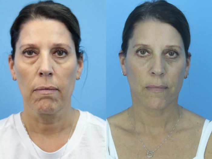 Before & After Blepharoplasty (Lower, Under Eyes) Case 419 Front View in West Des Moines & Ames, IA