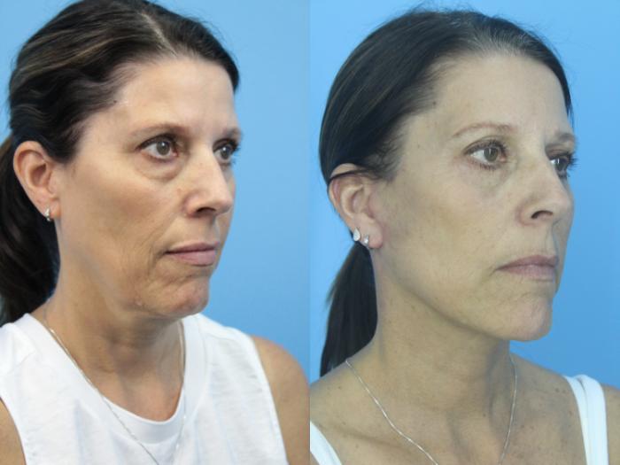 Before & After Blepharoplasty (Lower, Under Eyes) Case 419 Right Oblique View in West Des Moines & Ames, IA