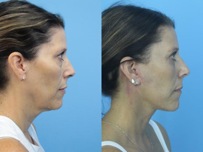 Before & After Facelift Case 419 Right Side View in West Des Moines & Ames, IA