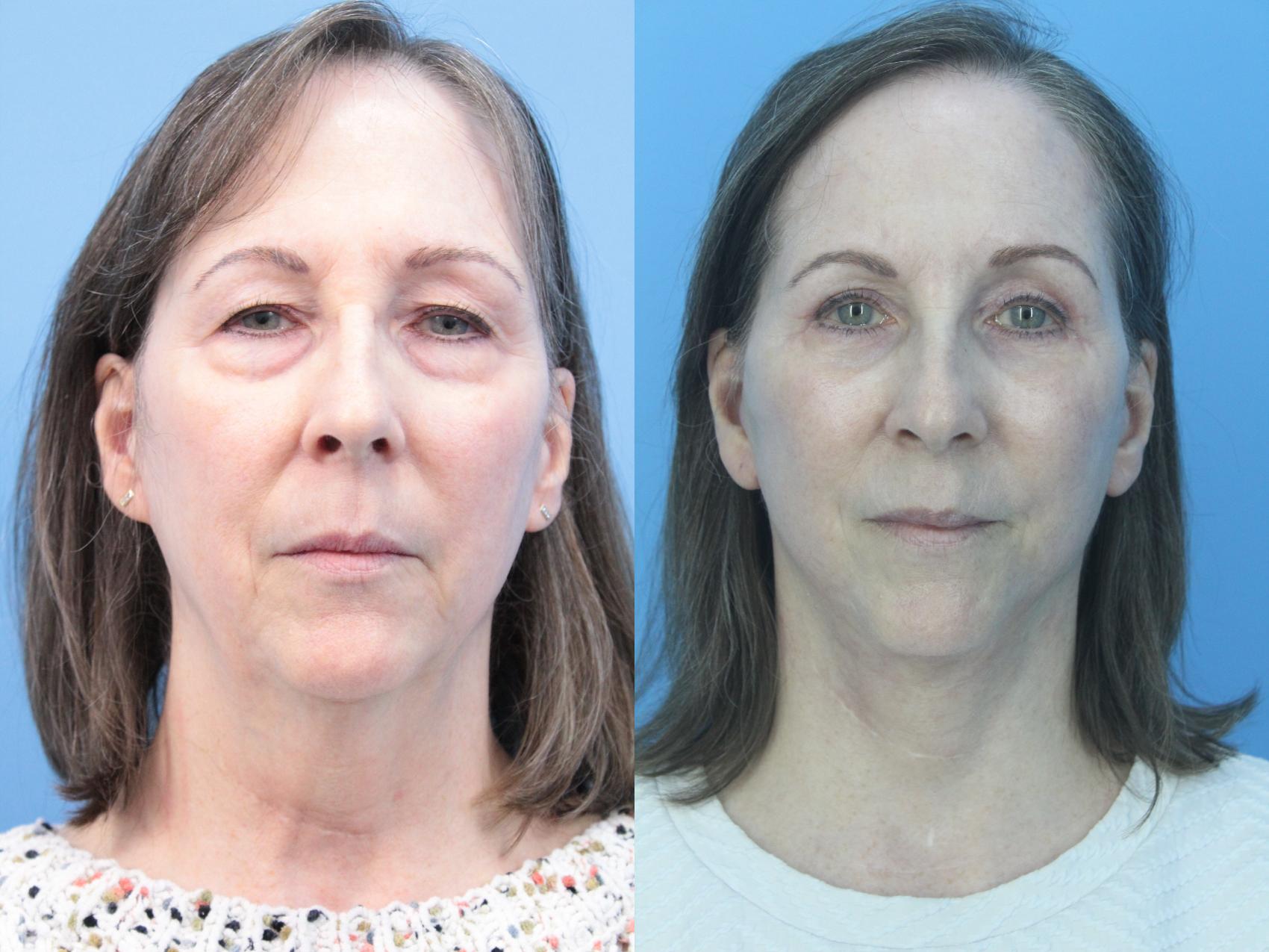 Before & After Facelift Case 431 Front View in West Des Moines & Ames, IA