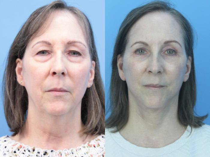 Before & After Blepharoplasty (Lower, Under Eyes) Case 431 Front View in West Des Moines & Ames, IA