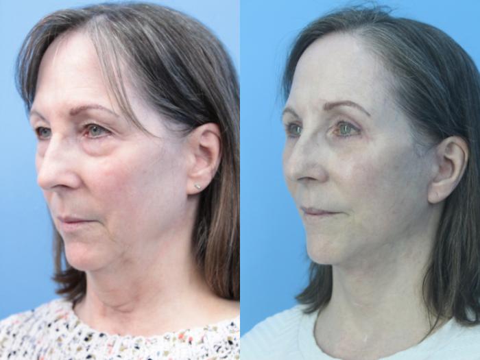 Before & After Facelift Case 431 Left Oblique View in West Des Moines & Ames, IA