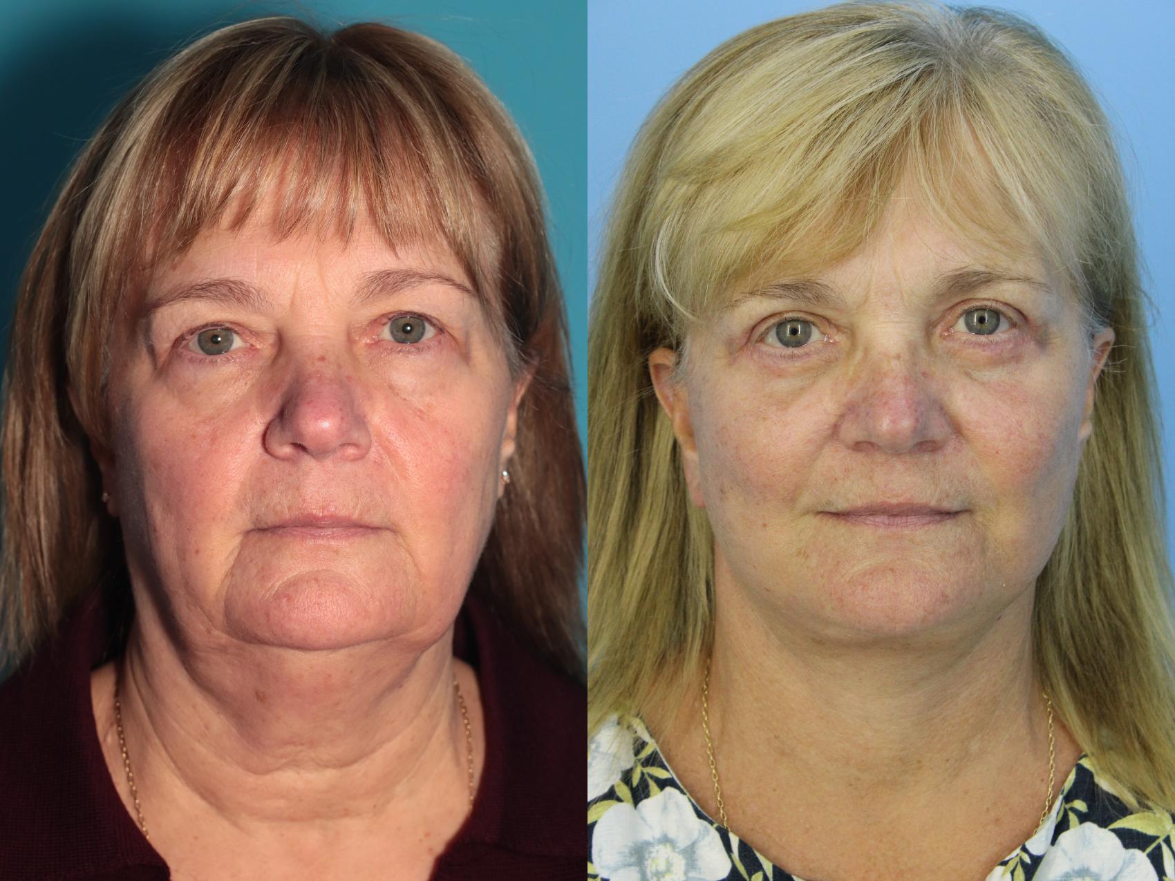 Before & After Facelift Case 437 Front View in West Des Moines & Ames, IA