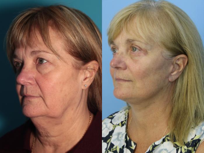 Before & After Facelift Case 437 Left Oblique View in West Des Moines & Ames, IA