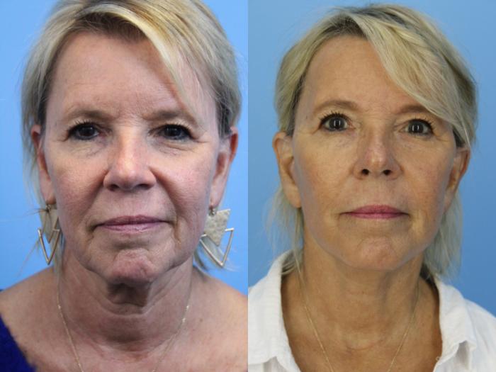 Before & After Facial Liposuction Case 445 Front View in West Des Moines & Ames, IA