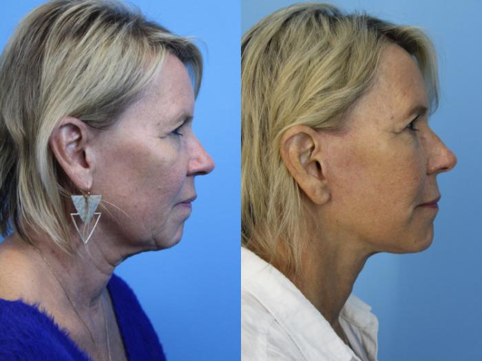 Before & After Facial Liposuction Case 445 Right Side View in West Des Moines & Ames, IA