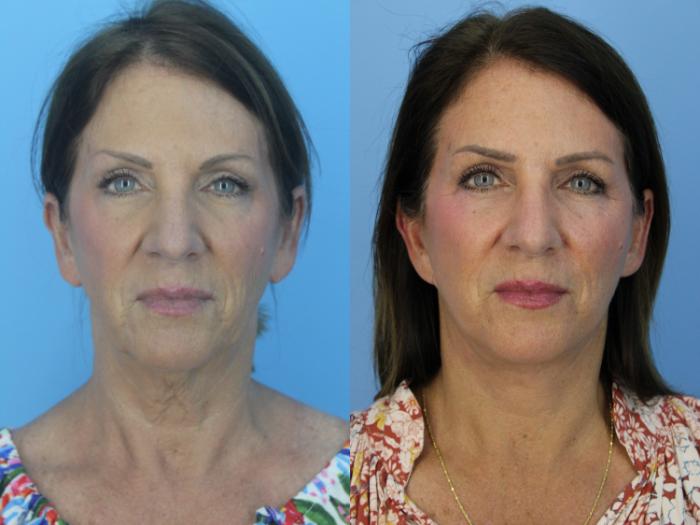 Before & After Facelift Case 452 Front View in West Des Moines & Ames, IA