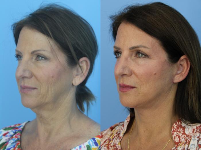 Before & After Facelift Case 452 Left Oblique View in West Des Moines & Ames, IA