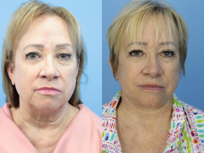 Before & After Facelift Case 453 Front View in West Des Moines & Ames, IA