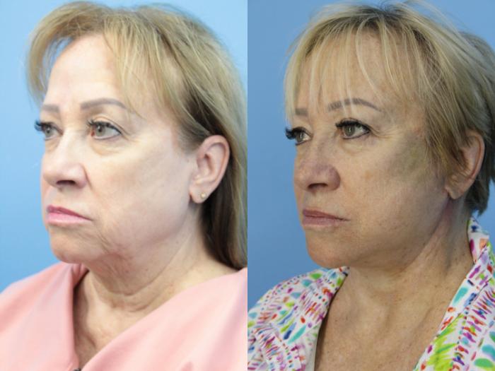 Before & After Facelift Case 453 Left Oblique View in West Des Moines & Ames, IA