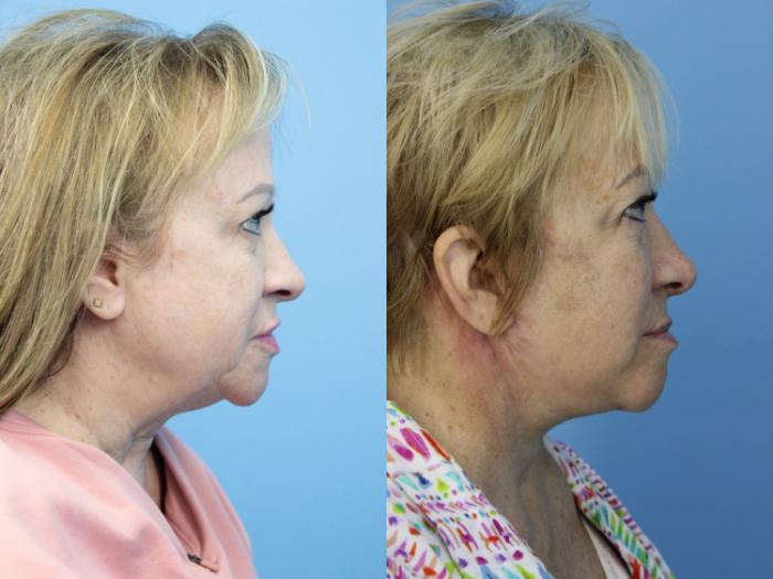 Before & After Facelift Case 453 Right Side View in West Des Moines & Ames, IA