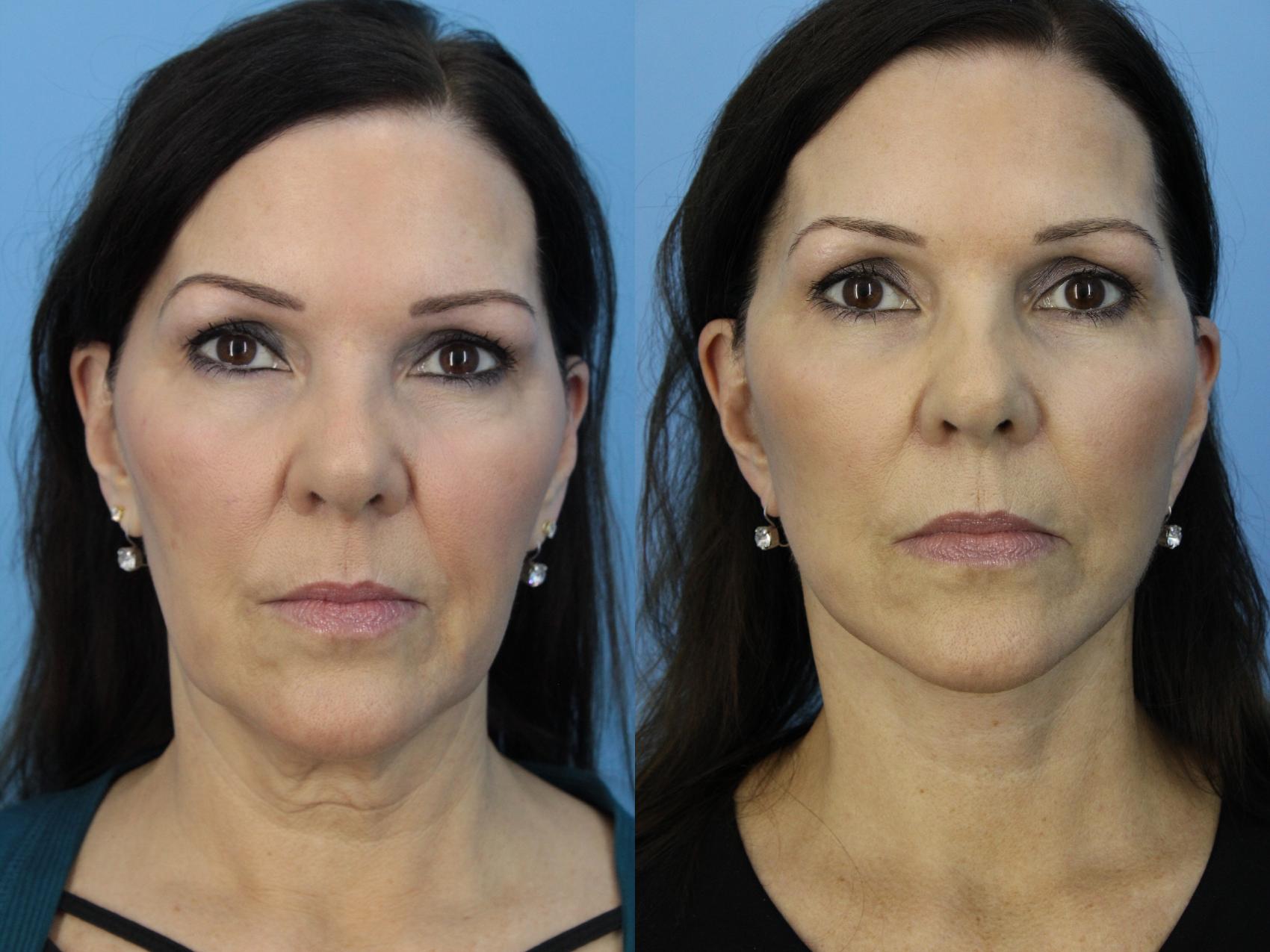 Before & After Facelift Case 455 Front View in West Des Moines & Ames, IA