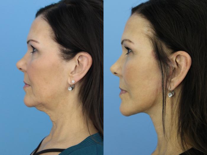 Before & After Facelift Case 455 Left Side View in West Des Moines & Ames, IA