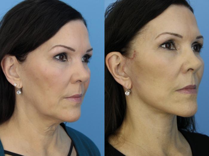 Before & After Facelift Case 455 Right Oblique View in West Des Moines & Ames, IA