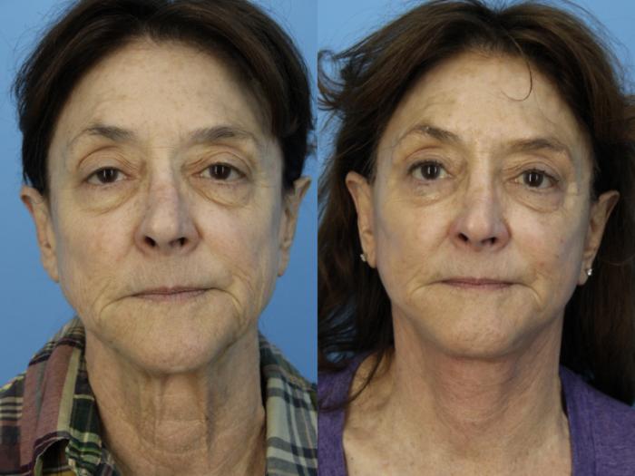 Before & After Facial Liposuction Case 458 Front View in West Des Moines & Ames, IA