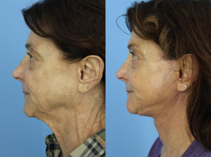 Before & After Facial Liposuction Case 458 Left Side View in West Des Moines & Ames, IA