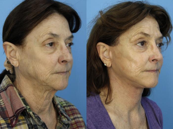 Before & After Facial Liposuction Case 458 Right Oblique View in West Des Moines & Ames, IA