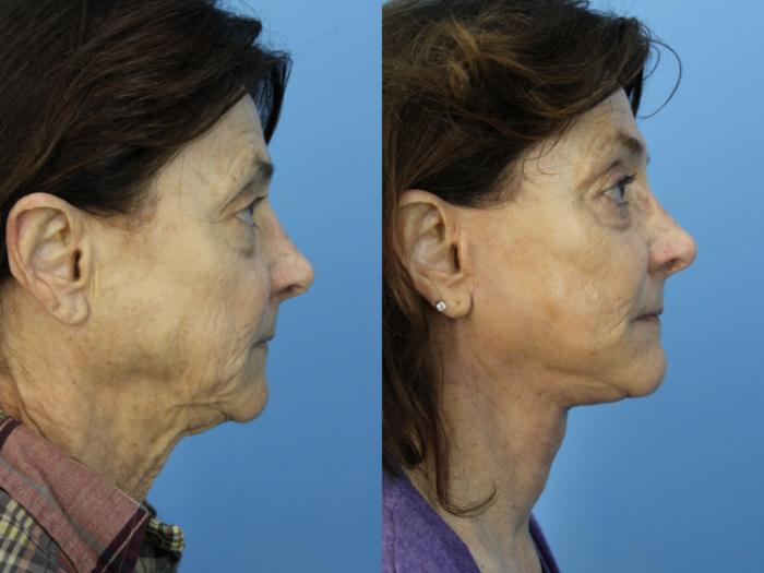 Before & After Facial Liposuction Case 458 Right Side View in West Des Moines & Ames, IA