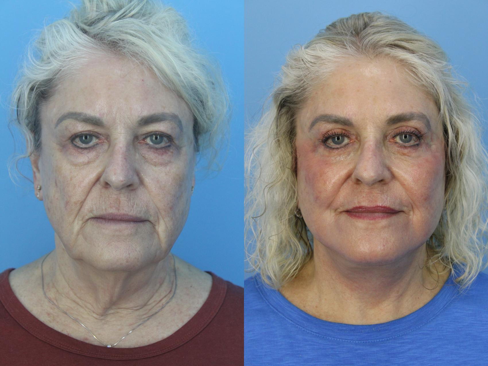 Before & After Facelift Case 459 Front View in West Des Moines & Ames, IA